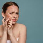Acne Around Mouth Treating Troublesome Spots