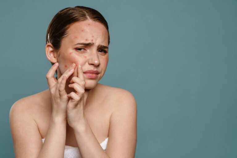 Acne Around Mouth Treating Troublesome Spots
